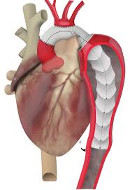 Aorta Prothese Implantat